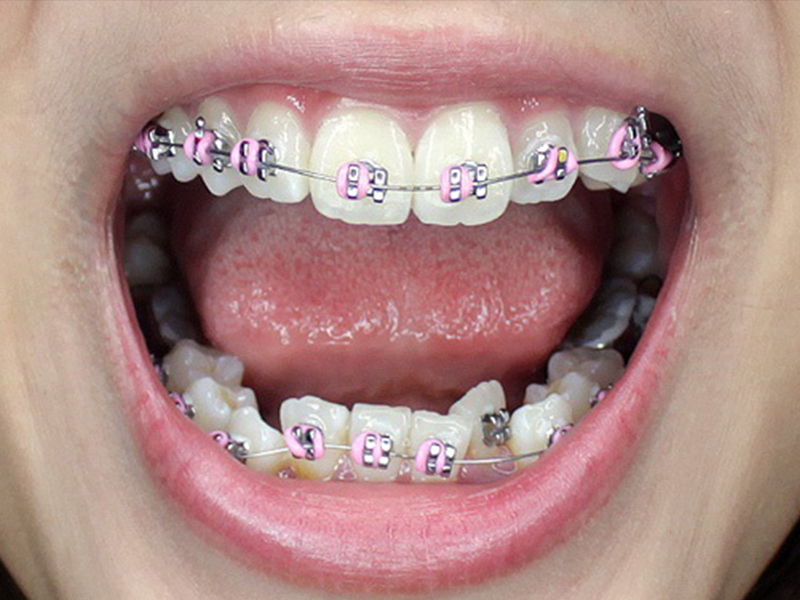 Niềng răng để có nụ cười đẹp - Niềng răng ở đâu là tốt nhất?