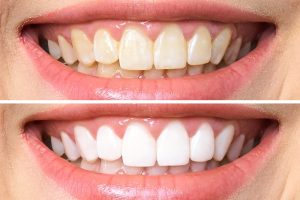 Nhiễm màu trên bề mặt răng