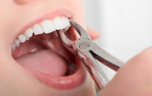 Nhổ răng số 4 khi niềng răng - Tại sao cần nhổ răng?