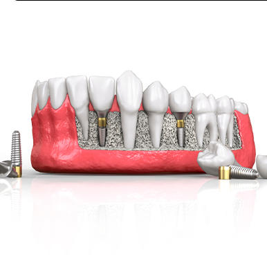 Cách bảo vệ răng Implant - Cách bảo vệ nào là hiệu quả nhất