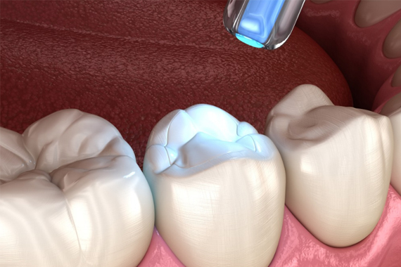 Hàn răng sâu - Kiến thức hữu ích dành cho những ai có vấn đề về răng