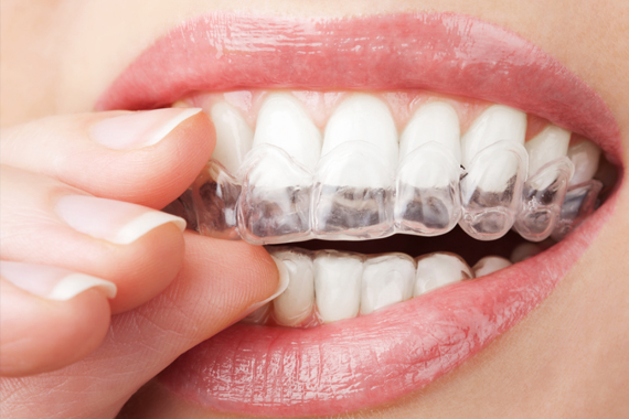 Răng móm gây mất thẩm mỹ - Nguyên nhân và giải pháp điều trị dứt điểm