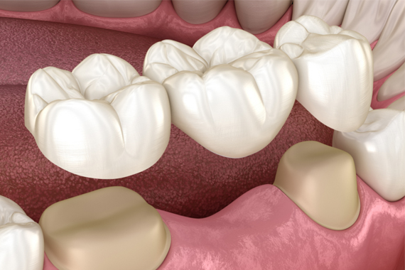 Trồng răng sứ và những cách giữ "tuổi thọ" răng sứ được lâu nhất