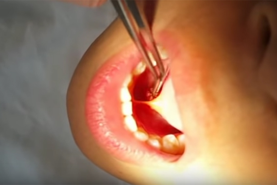 Vị trí dính phanh lưỡi ở trẻ - Nên hay không nên phẫu thuật cắt bỏ?