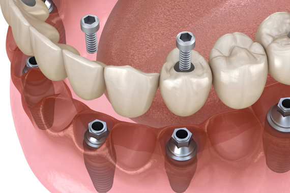 Chi phí trồng răng Implant - Trồng Implant all on 4 có đắt không?
