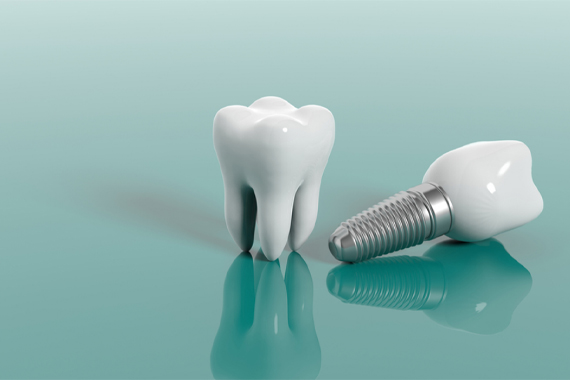 Trường hợp trồng răng Implant - Trường hợp nào nên trồng?