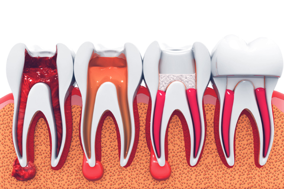 Điều trị tủy răng là gì? Những trường hợp nào cần điều trị tủy?