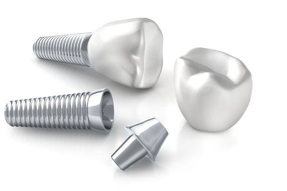 Tình trạng mất răng - So sánh giữa trồng răng Implant và làm cầu răng sứ