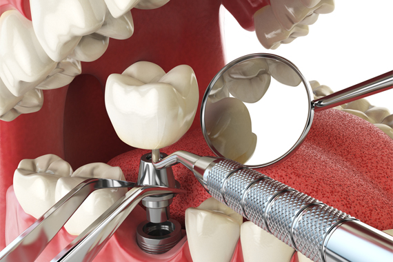 ưu điểm trồng răng implant