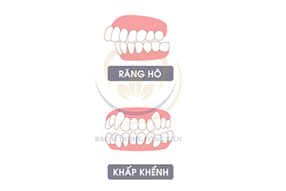 Răng bị hô - Những ảnh hưởng của tình trạng răng hô?