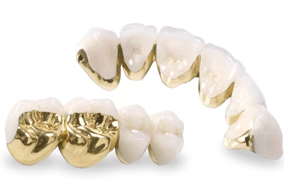 Răng sứ kim loại - Trên thị trường hiện nay có những loại sứ kim loại nào?