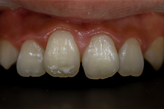Điểm lại các nguyên nhân gây nên đốm trắng trên răng