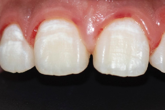 Định nghĩa về đốm trắng trên răng