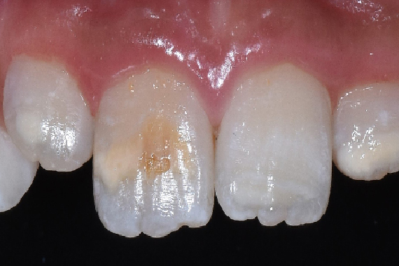 Đốm trắng - Nguyên nhân từ việc mất khoáng men răng