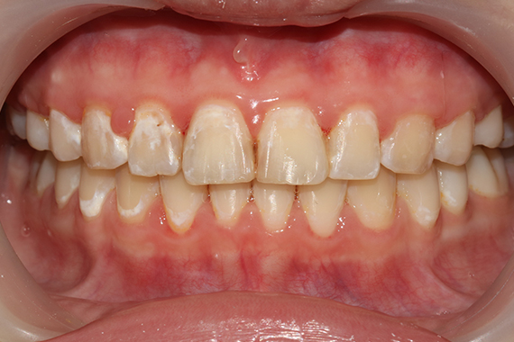 Răng bị nhiễm fluor xuất hiện đốm trắng