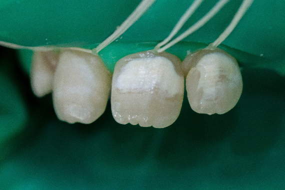 Răng bị vôi hóa trong quá trình niềng
