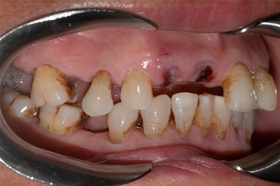 Tình trạng mất răng - Nên trồng Implant hay làm cầu răng?