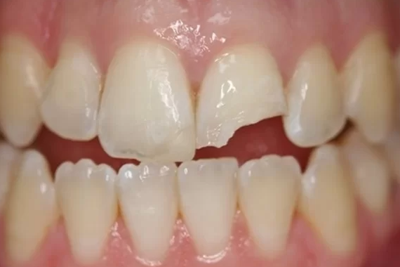 Răng bị gãy thì phải làm sao? Cách xử lý tình trạng răng bị gãy